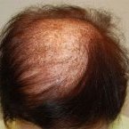 Wyliniały hełmofon